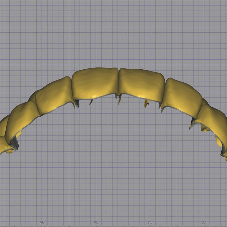 Dental Digital Mutilunit Veneer Design factory