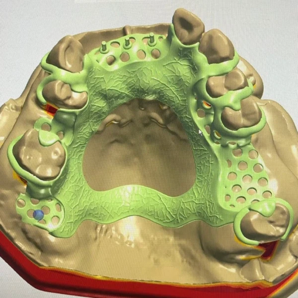 Dental Digital Metal Frame Design