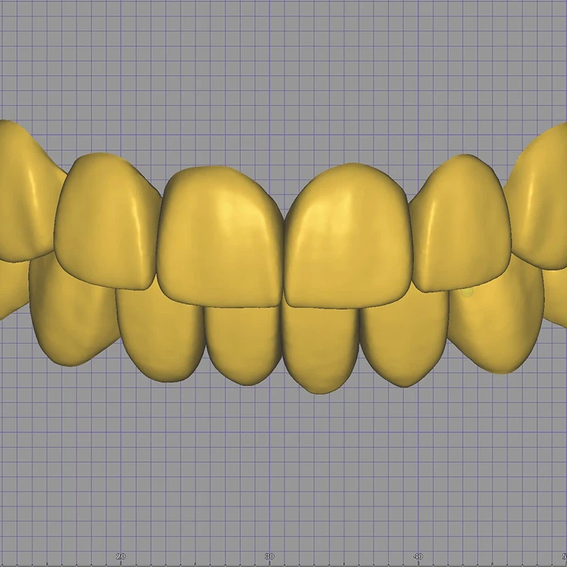 Dental Digital Mutilunit Veneer Design