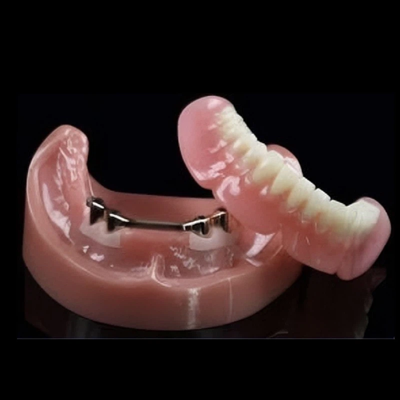 Dental Implant Supported Denture