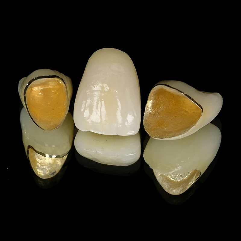 Dental Porcelain Fused To High Noble Metal Crown