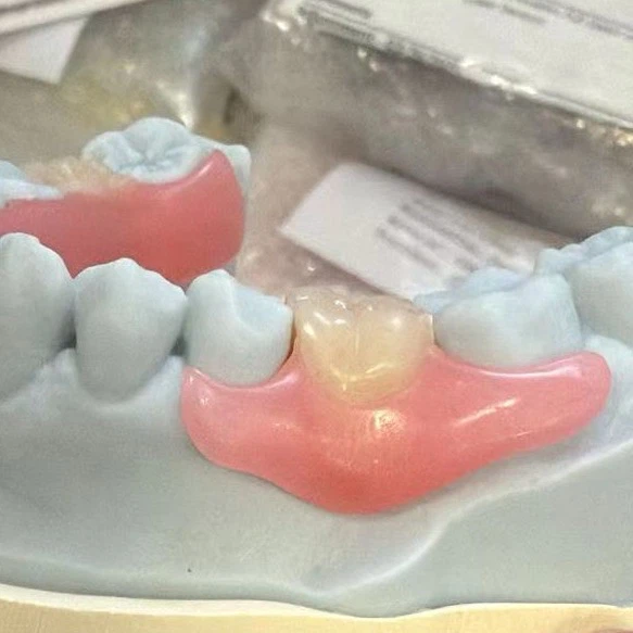 Flexible Non Metal Valplast Clasp