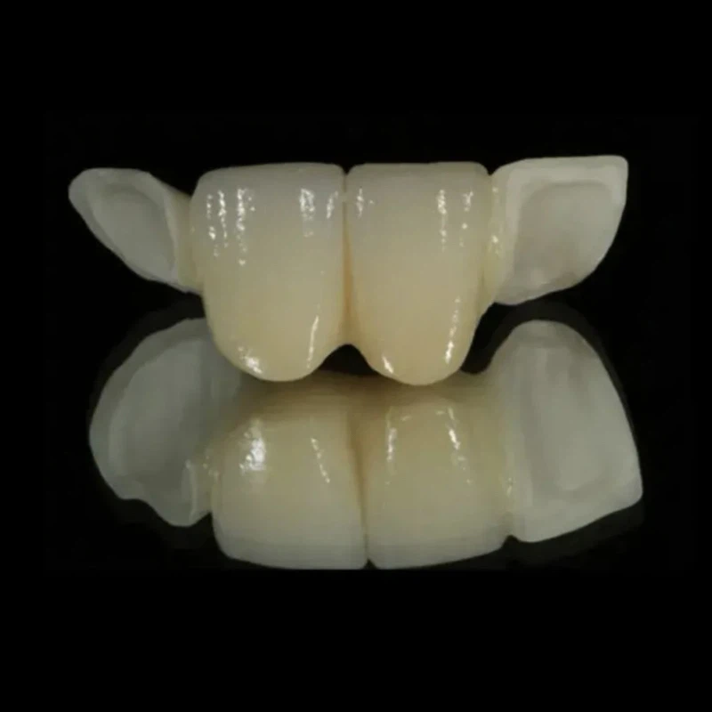 Posterior Zirconium Maryland Bridge