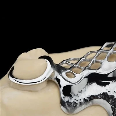 Chiusura di metallo dentale convenzionale