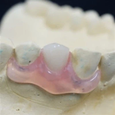 I denti anteriori Nesbit Valplast possono essere rimossi facilmente?