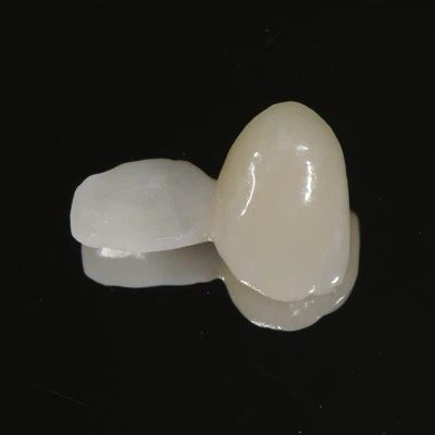 È possibile utilizzare un ponte dentale Maryland per i denti anteriori?